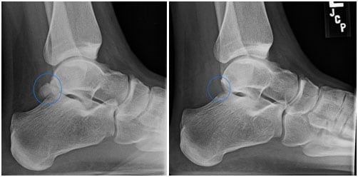 x-rays showing the os trigonum surgery before and after